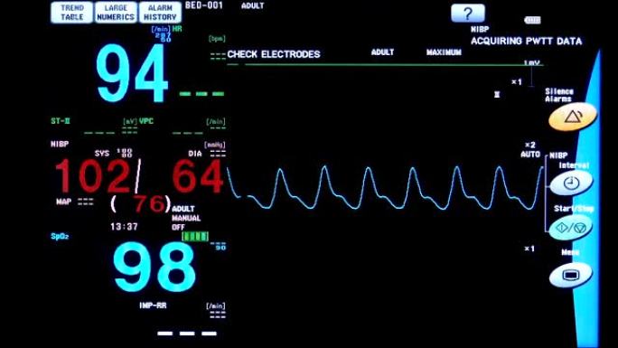 手术室心脏监护仪的特写。心电监护仪显示患者背景的心率