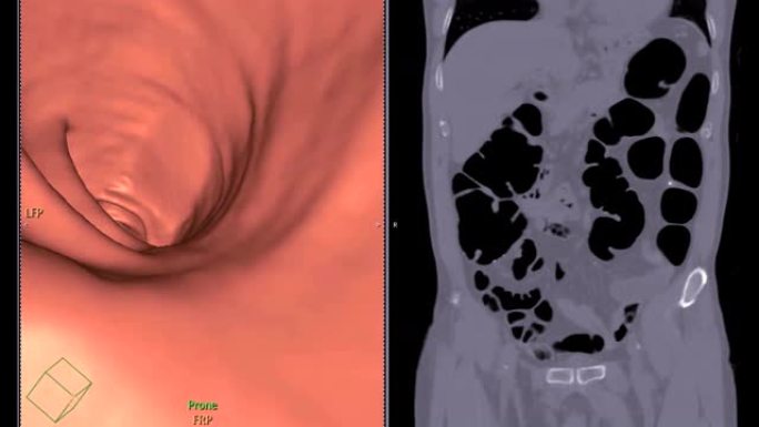 CT结肠造影或ct扫描的结肠比较3D渲染飞穿程序和冠状视图的ct扫描。