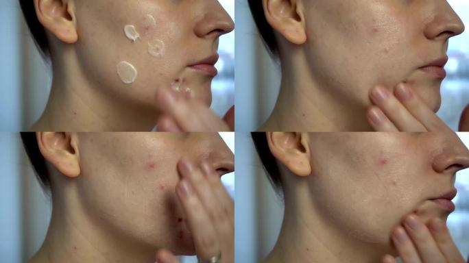 关闭皮肤问题 (不健康的皮肤痤疮和丘疹)。问题皮肤的治疗。