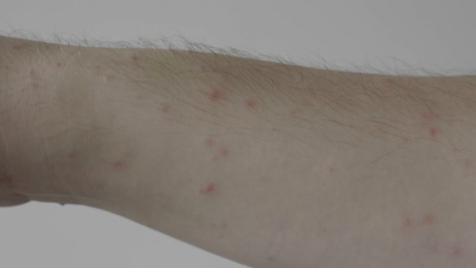 青少年敏感的皮肤发痒，出现手臂发红皮疹湿疹或过敏症状