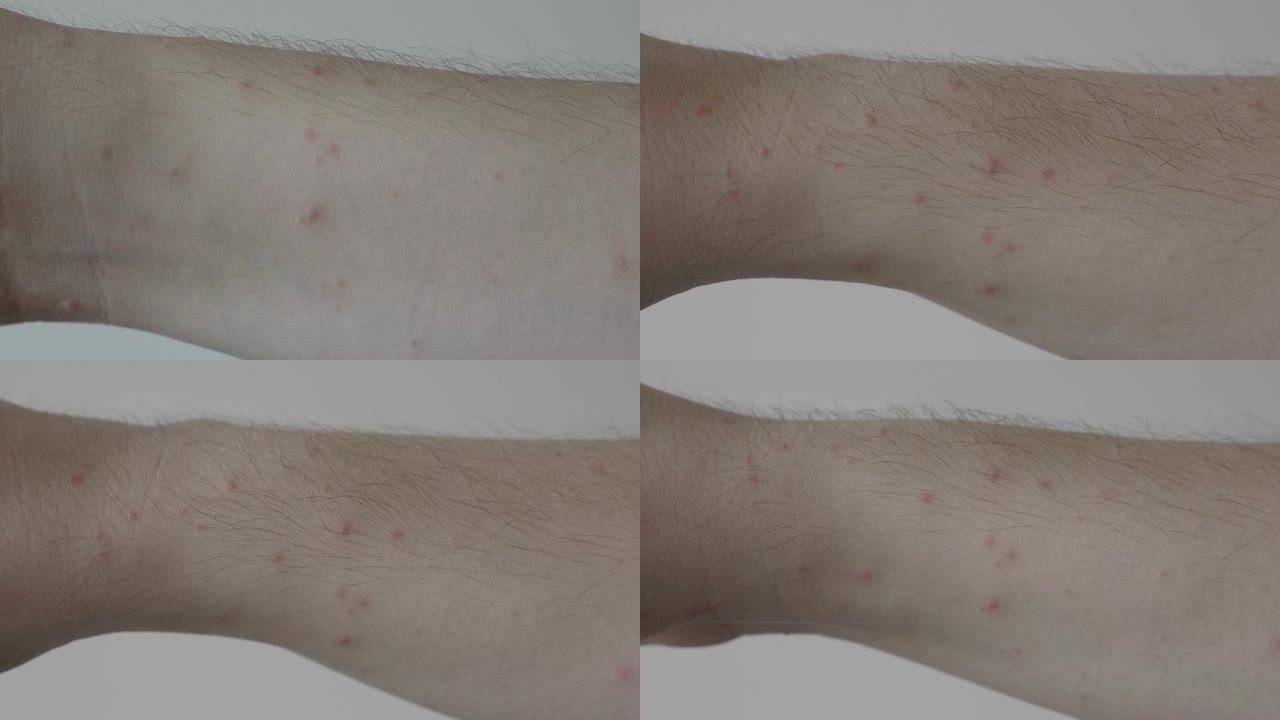 由过敏或病毒性疾病引起的患有水痘或湿疹的年轻人手臂上的红点特写