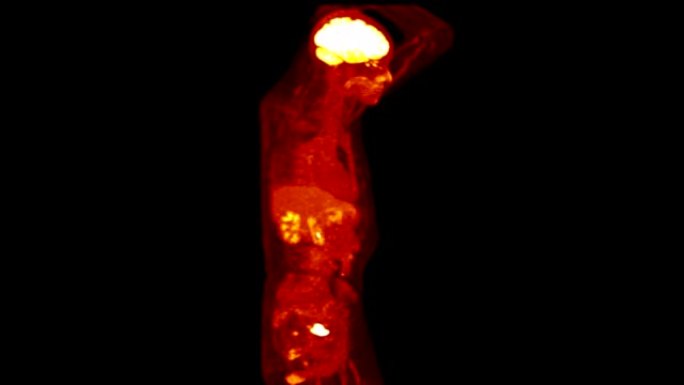 PET CT (正电子发射断层扫描) 的整个人体3d渲染图像红色。