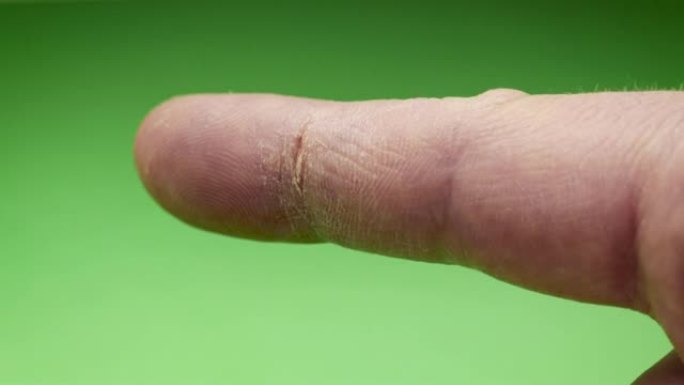 手部护理。皮肤干燥，食指指骨上有裂纹