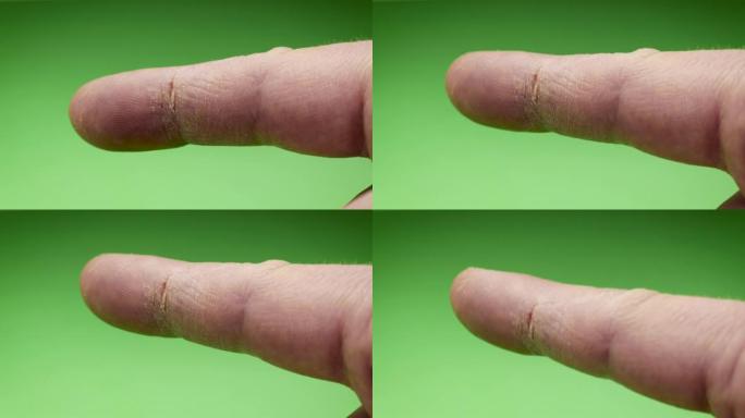 手部护理。皮肤干燥，食指指骨上有裂纹