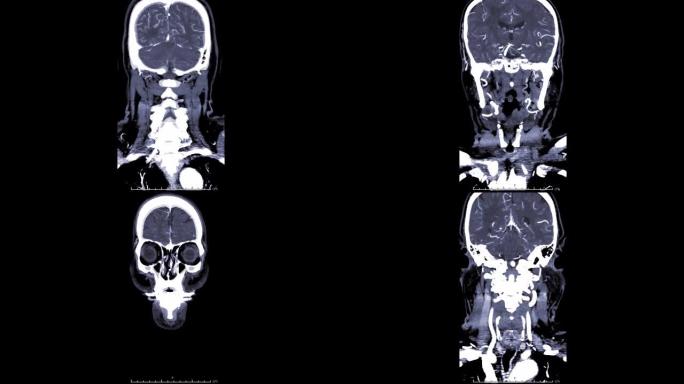 计算机断层扫描血管造影，CTA脑3D渲染矢状面从左到右显示脑血管的冠状视图。
