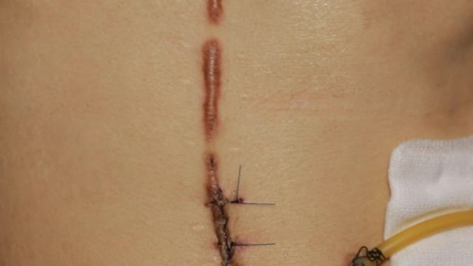 黑色纤维手术留下的疤痕。手术后缝合皮肤以去除癌性痣