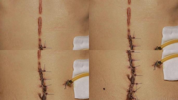 黑色纤维手术留下的疤痕。手术后缝合皮肤以去除癌性痣