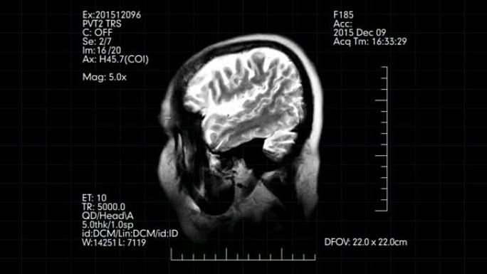 带有医学数据的黑白MRI脑部扫描轮廓动画