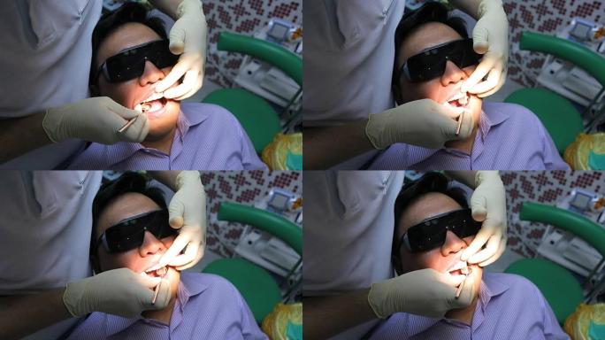 牙医正在用口腔镜治疗客户的牙齿