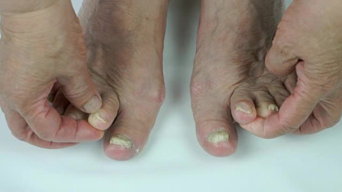 真菌感染妇女的脚趾甲
