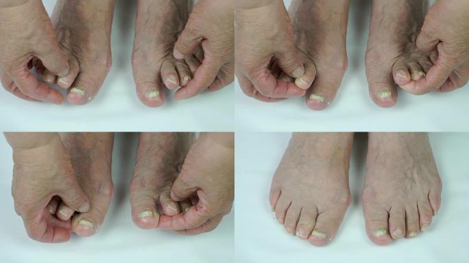 真菌感染妇女的脚趾甲