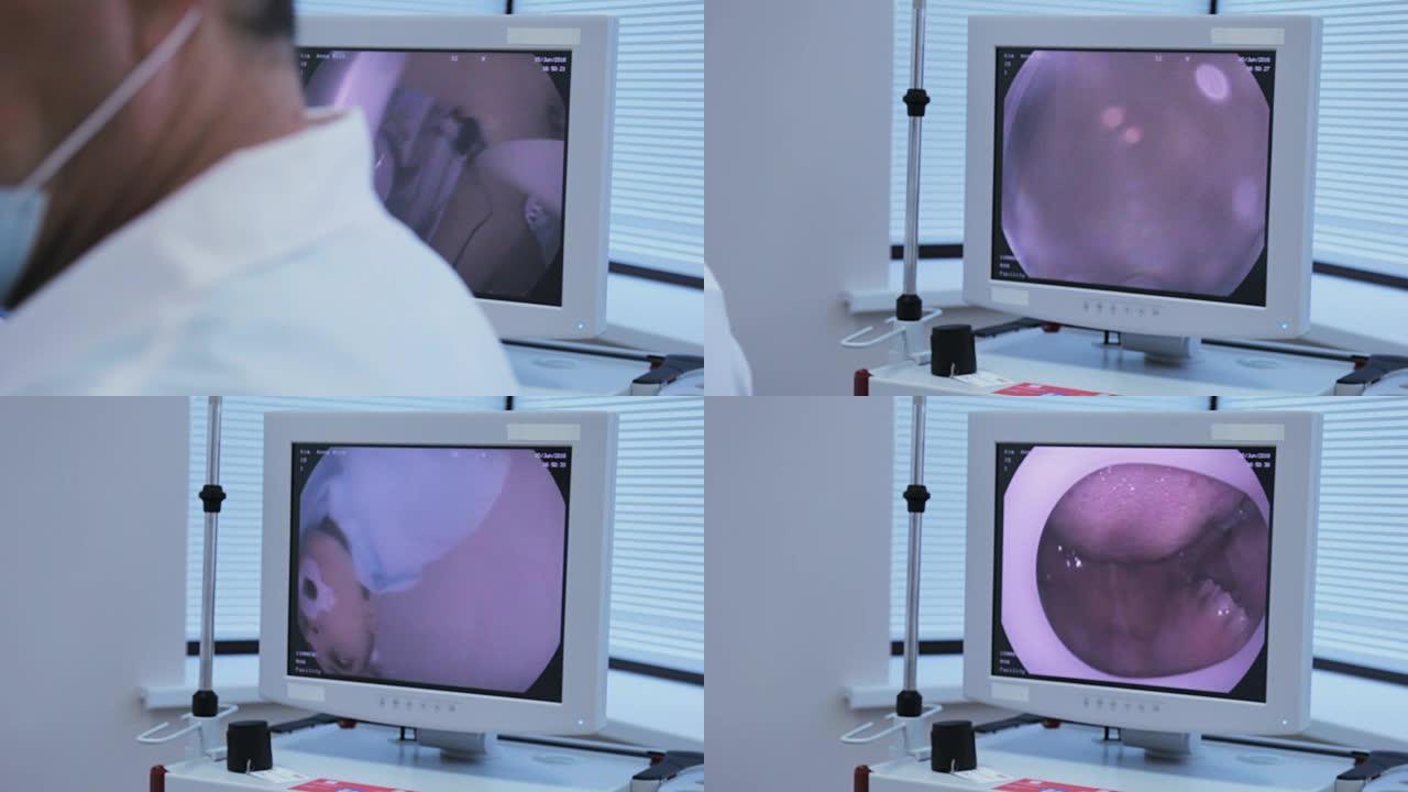 监控内窥镜，医生将他的相机胃镜通过病人的嘴贴在病人身上