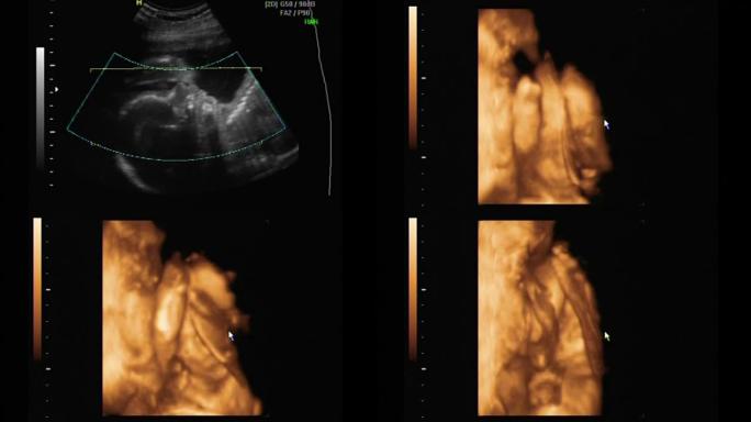 孕23周时一个美婴的2D和3D超声