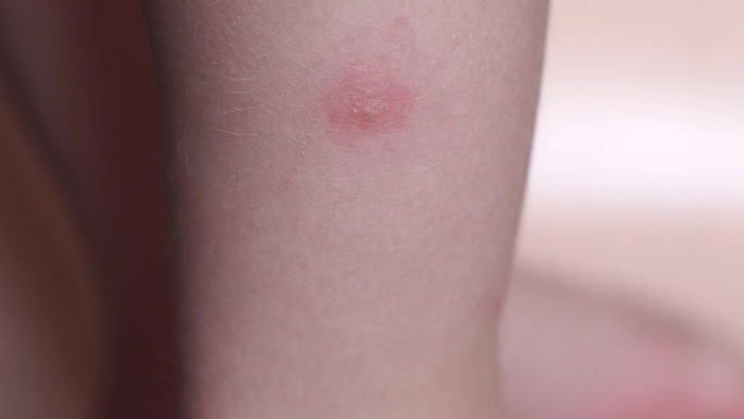 蜱咬在一个小孩的腿上。