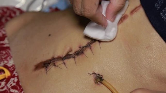 用黑色纤维清除手术中的疤痕。手术后缝合皮肤以去除癌性痣