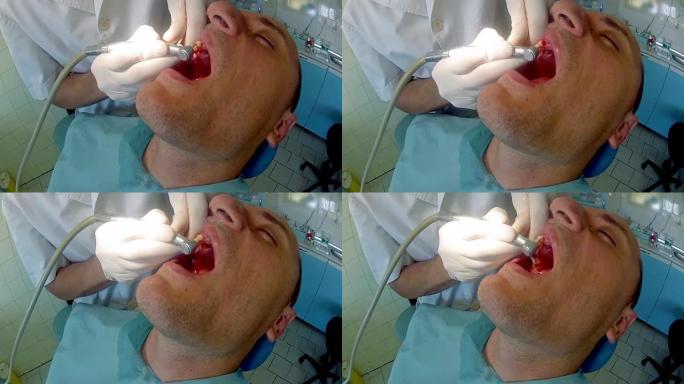 由于牙医的干预，患者的牙龈正在流血，请关闭
