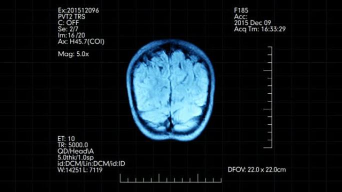 MRI脑部扫描未来蓝色显示