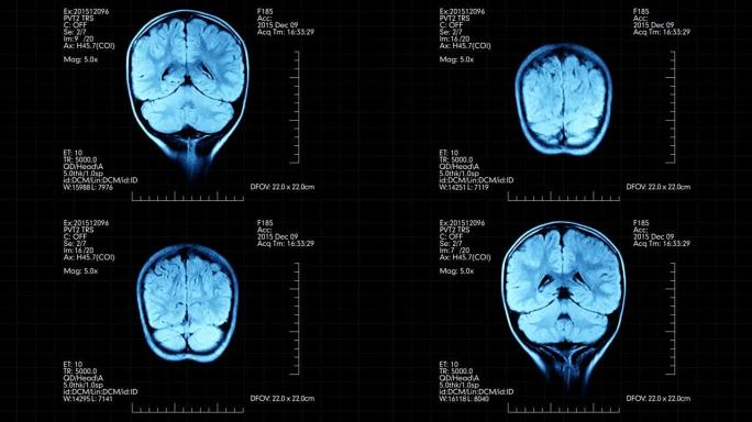 MRI脑部扫描未来蓝色显示