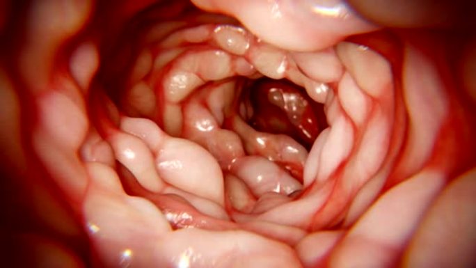 受Morbus Crohn影响的肠道