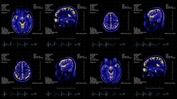 MRI脑部扫描未来显示蓝色和橙色与心跳率监视器
