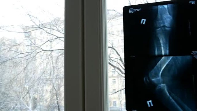 X射线照片显示膝关节并关节病