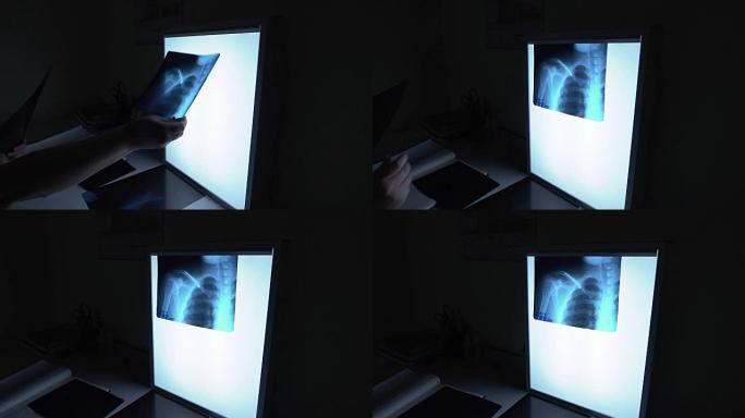医生看了x光。图像显示锁骨，肋骨和肺。用骨中的支架愈合骨折的过程。黑暗的房间