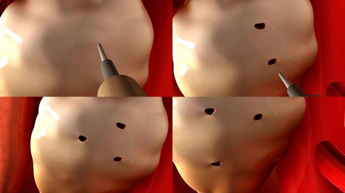 腹腔镜卵巢钻孔术