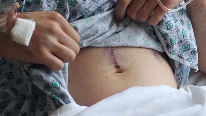 医院患者提起衬衫以显示前列腺手术的手术疤痕