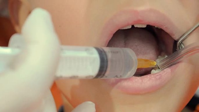 牙医用注射器和真空吸尘器在孩子的嘴里操作