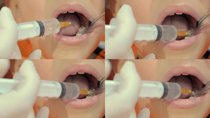 牙医用注射器和真空吸尘器在孩子的嘴里操作