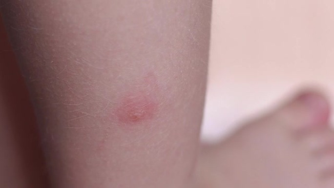 腿上被蚊子叮咬的小孩。