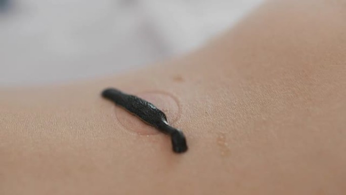 水蛭疗法在女性皮肤上的临床应用