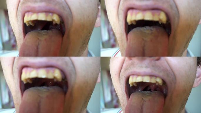 男人张开嘴，用舌头和扁桃体显示喉咙。患有龋齿和牙结石的口腔和牙齿吸烟者