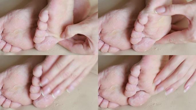 皮肤剥落的女性脚。手术后的脚擦洗