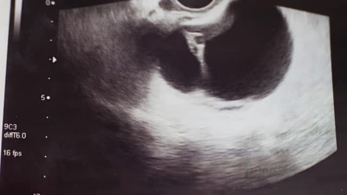 医学超声照片特写，女性卵巢伴左卵巢囊肿病理，医院急诊手术