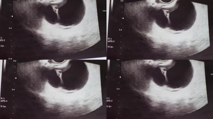 医学超声照片特写，女性卵巢伴左卵巢囊肿病理，医院急诊手术