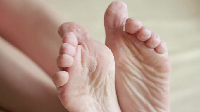皮肤剥落的女性脚。手术后的脚擦洗