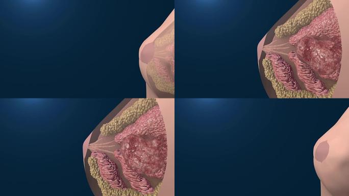 乳腺癌细胞生长动画。