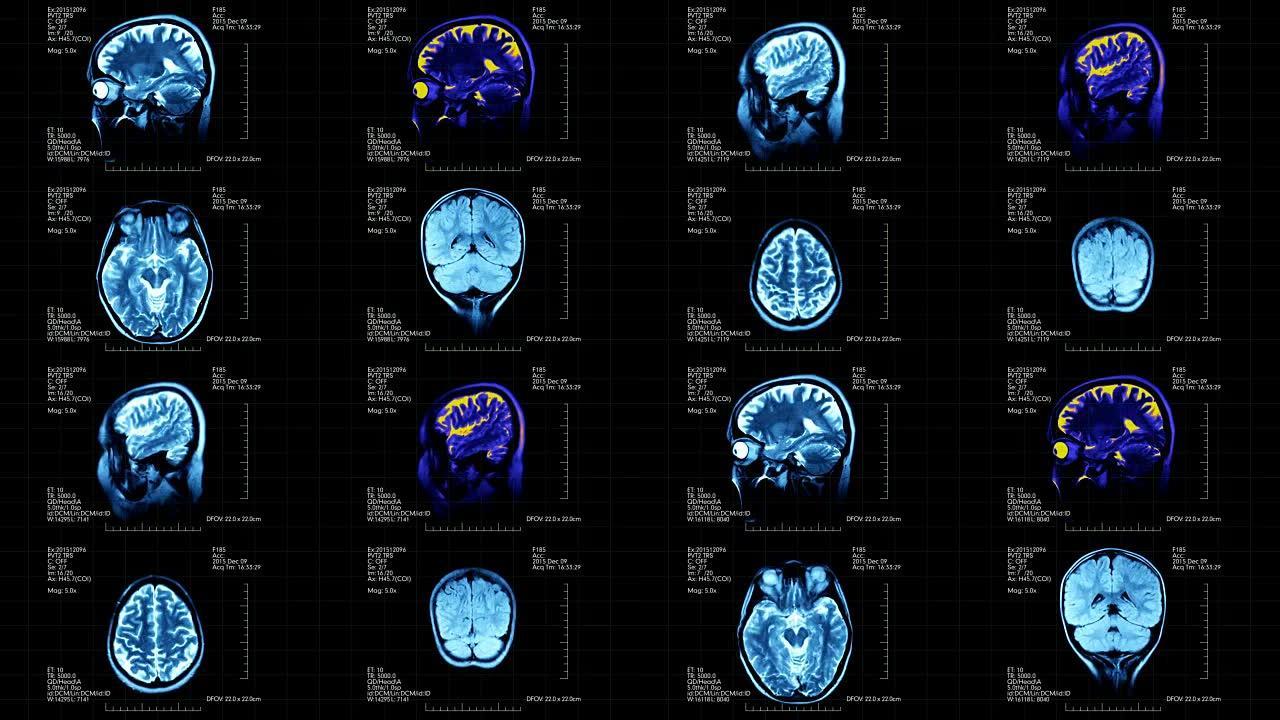 在一个具有详细医学数据的未来派显示器上显示了MRI脑部扫描的四张不同图片