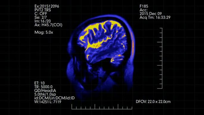 双色蓝色和橙色侧视图mri脑部扫描与医学数据显示动画