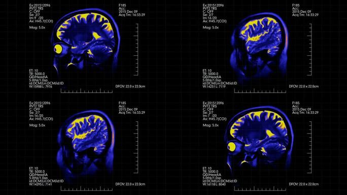 双色蓝色和橙色侧视图mri脑部扫描与医学数据显示动画