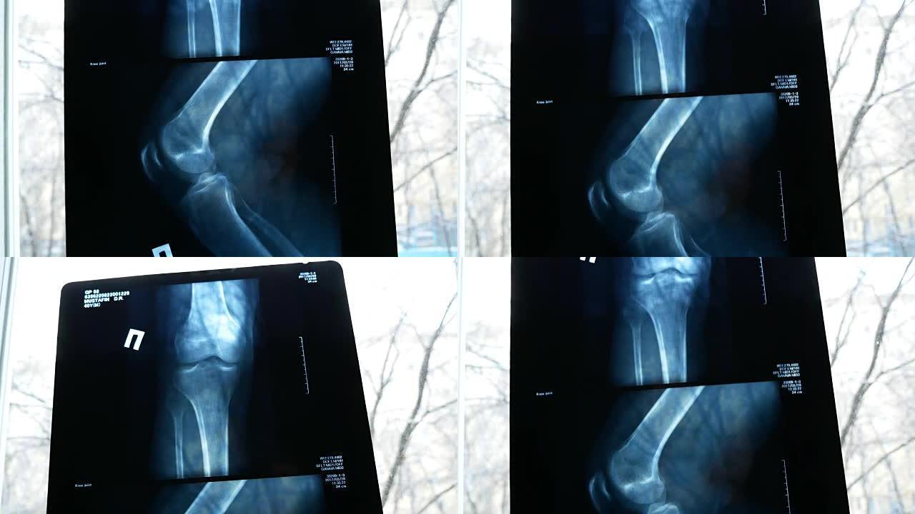 X射线照片显示膝关节并关节病