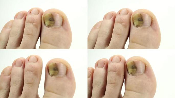 生病的指甲。大脚趾真菌。钉子与钉床的分离