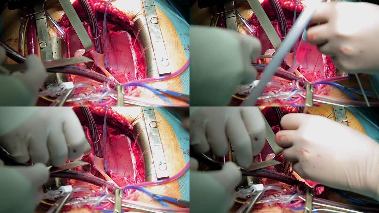 医生外科医生进行心脏直视手术。特写