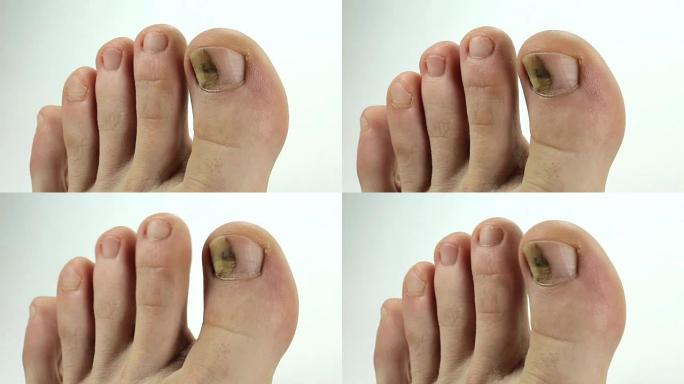有真菌感染的趾甲。生病的指甲。大脚趾真菌