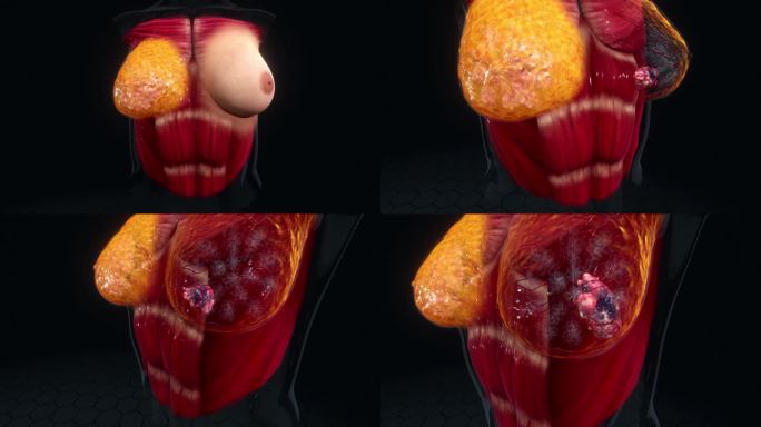 乳房肿瘤三维动画