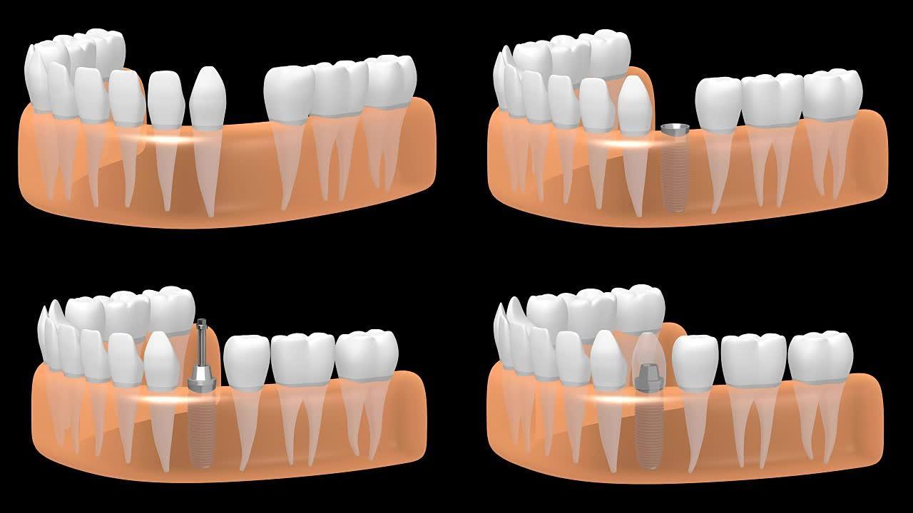3D牙种植体/牙种植体