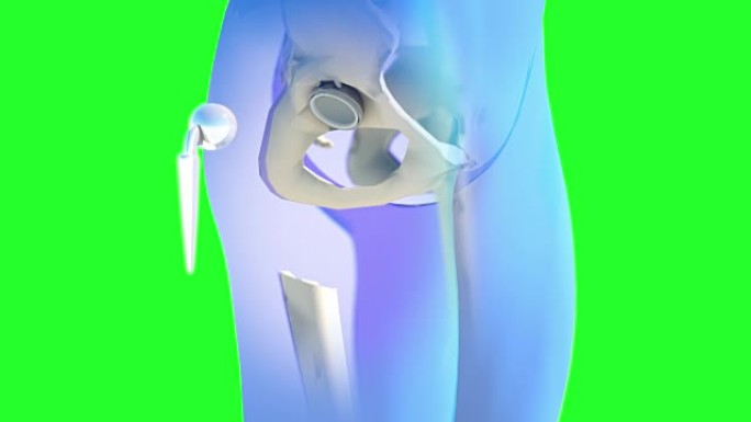 髋关节置换植入物安装在骨盆骨。医学上精确的3D动画