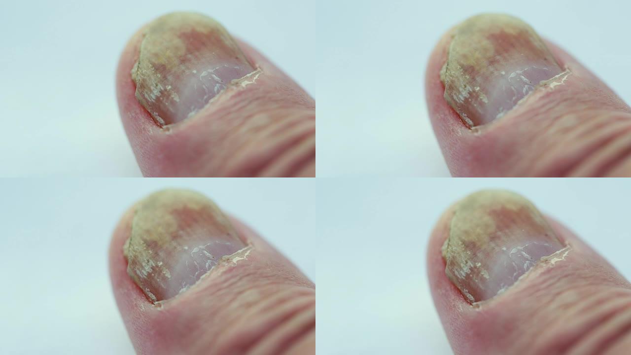 指甲上的真菌
