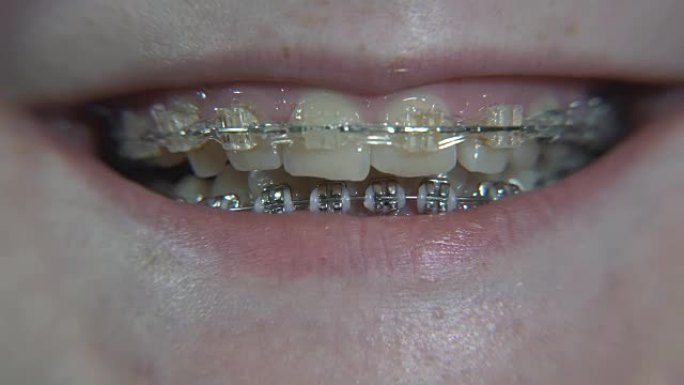 牙套。戴牙套的女孩在微笑。绿色rir
